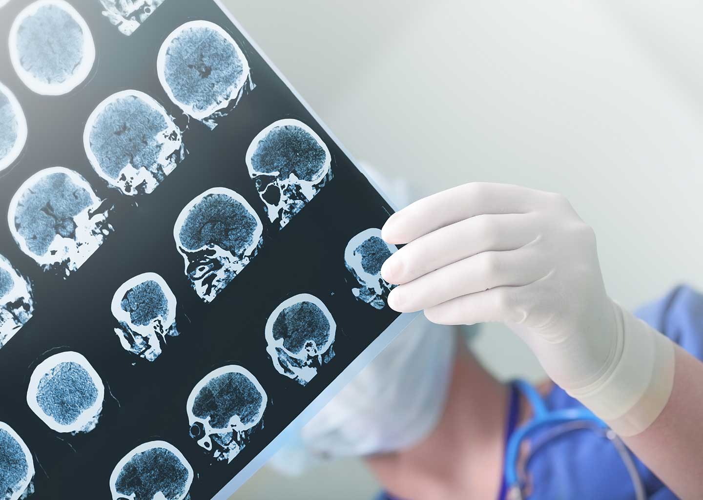 Brain Injury Lawyers Philadelphia Head Trauma Attorneys PA
